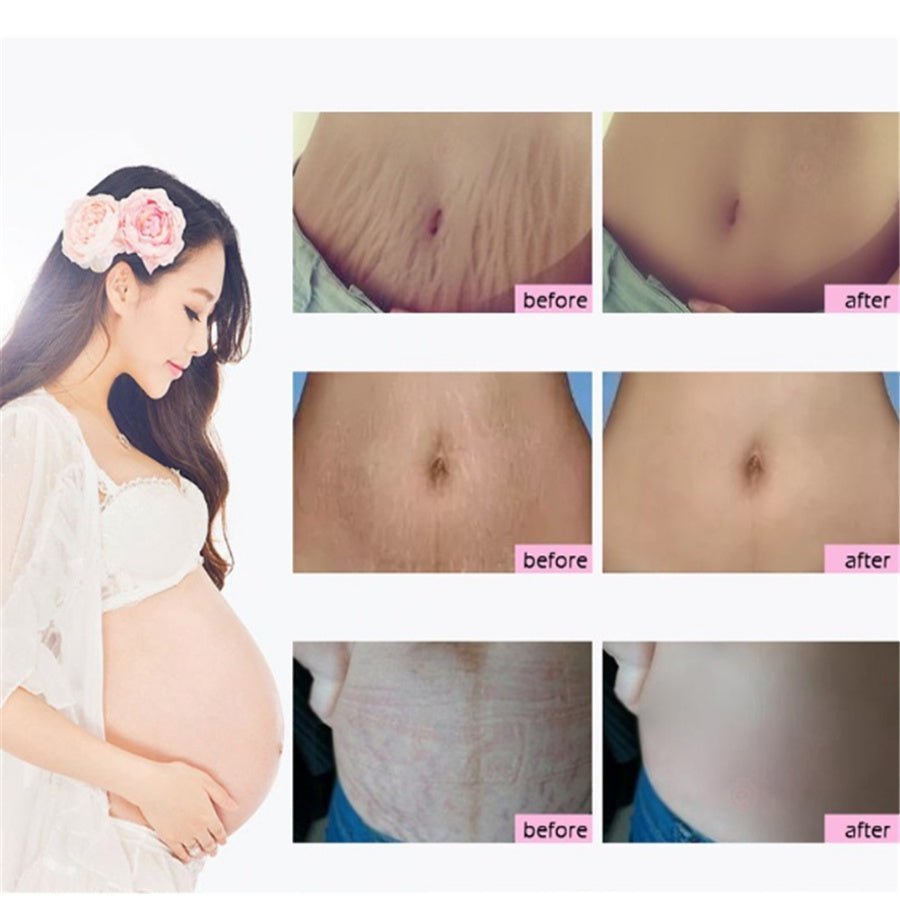 Natural Mild Non - irritating Mango Remove Stretch Mark Cream For Pregnancy Repair Scar Slack Line Abdomen Stretch Marks Cream - MEDIJIX